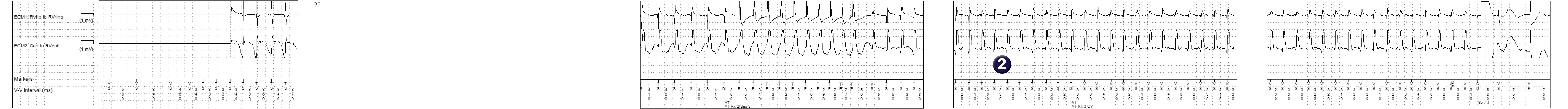 Medtronic ICD electrogram, segment 1 of 3 — Acceleration after several sequences of anti-tachycardia pacing