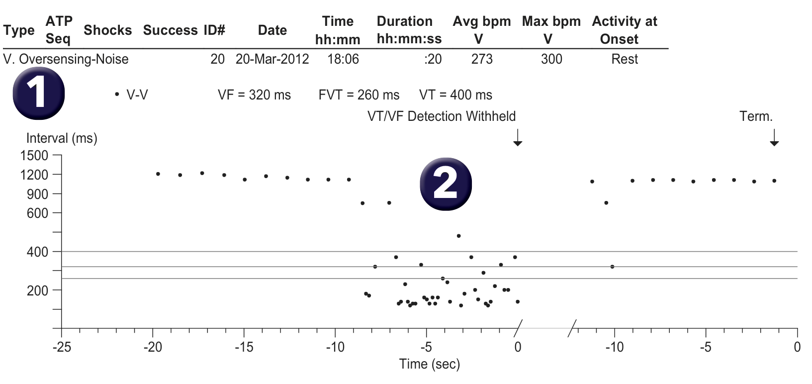 Medtronic ICD electrogram, segment 1 of 1 — Use of an algorithm to avoid inappropriate therapies