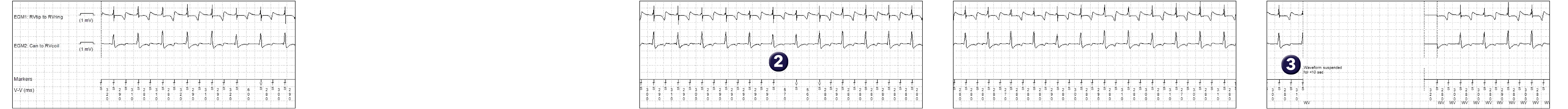 Medtronic ICD electrogram, segment 1 of 2 — The unexpected behaviour of an algorithm