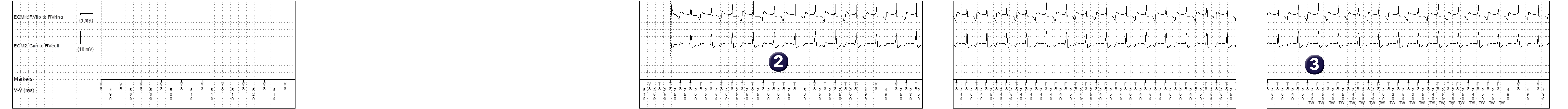 Medtronic ICD electrogram, segment 1 of 2 — Use of a specific algorithm