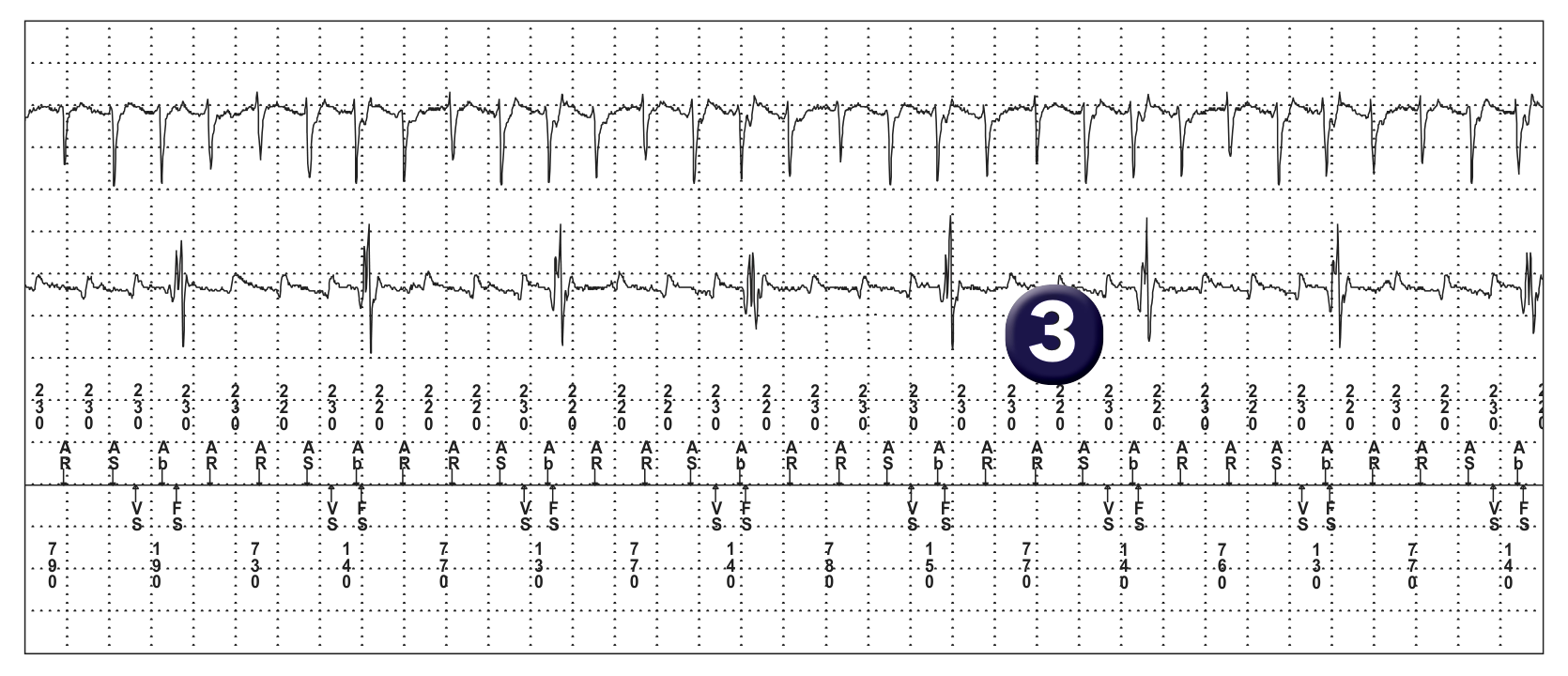 Medtronic ICD electrogram, segment 1 of 1 — Oversensing and integrated bipolar mode
