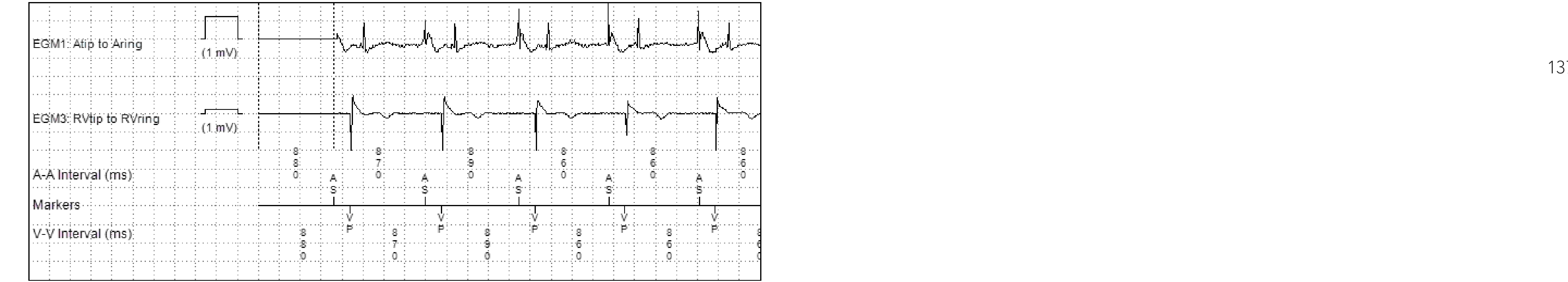Medtronic ICD electrogram, segment 2 of 2 — An unexpected cause of syncope