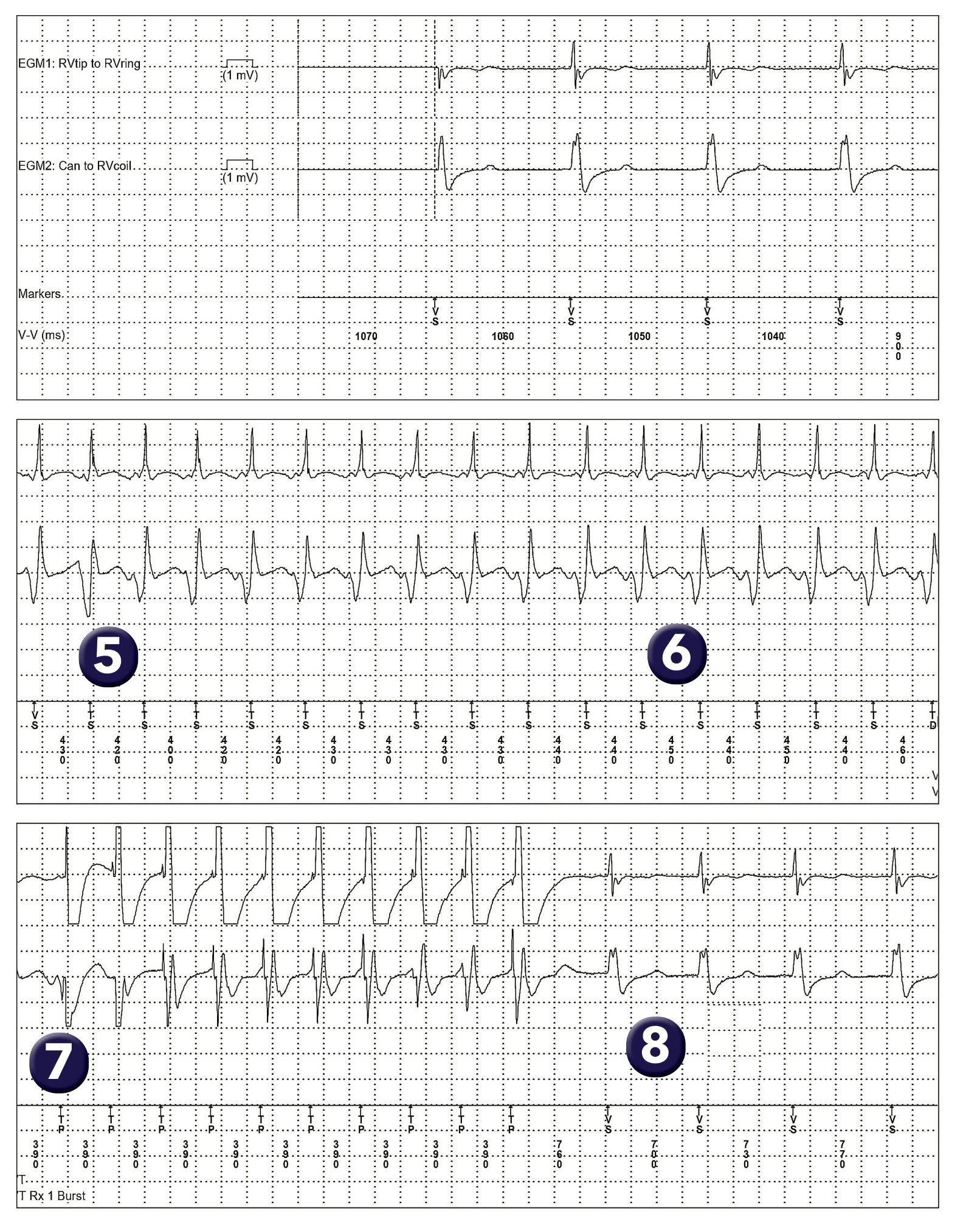 Medtronic ICD electrogram, segment 1 of 1 — Discriminators available on a single-chamber defibrillator