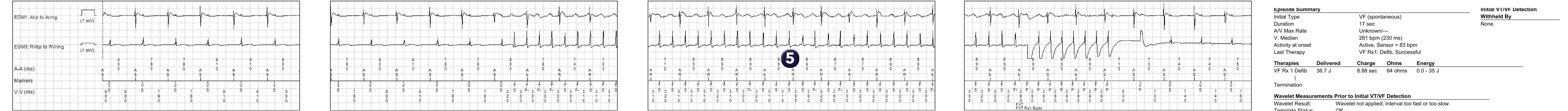 Medtronic ICD electrogram, segment 1 of 1 — Dual-chamber defibrillator and atrioventricular dissociation