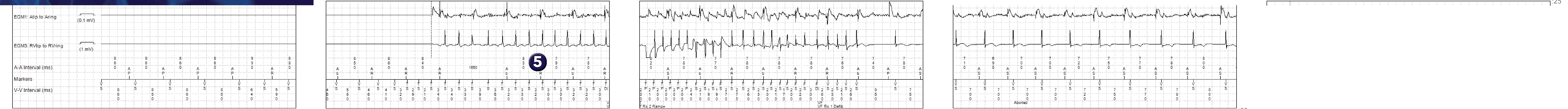 Medtronic ICD electrogram, segment 1 of 1 — PR Logic versus Wavelet