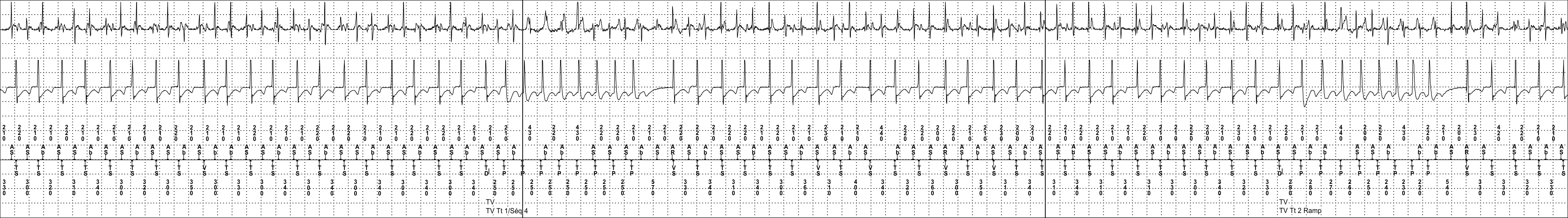 Medtronic ICD electrogram, segment 3 of 4 — Dual-chamber discrimination and atrial detection