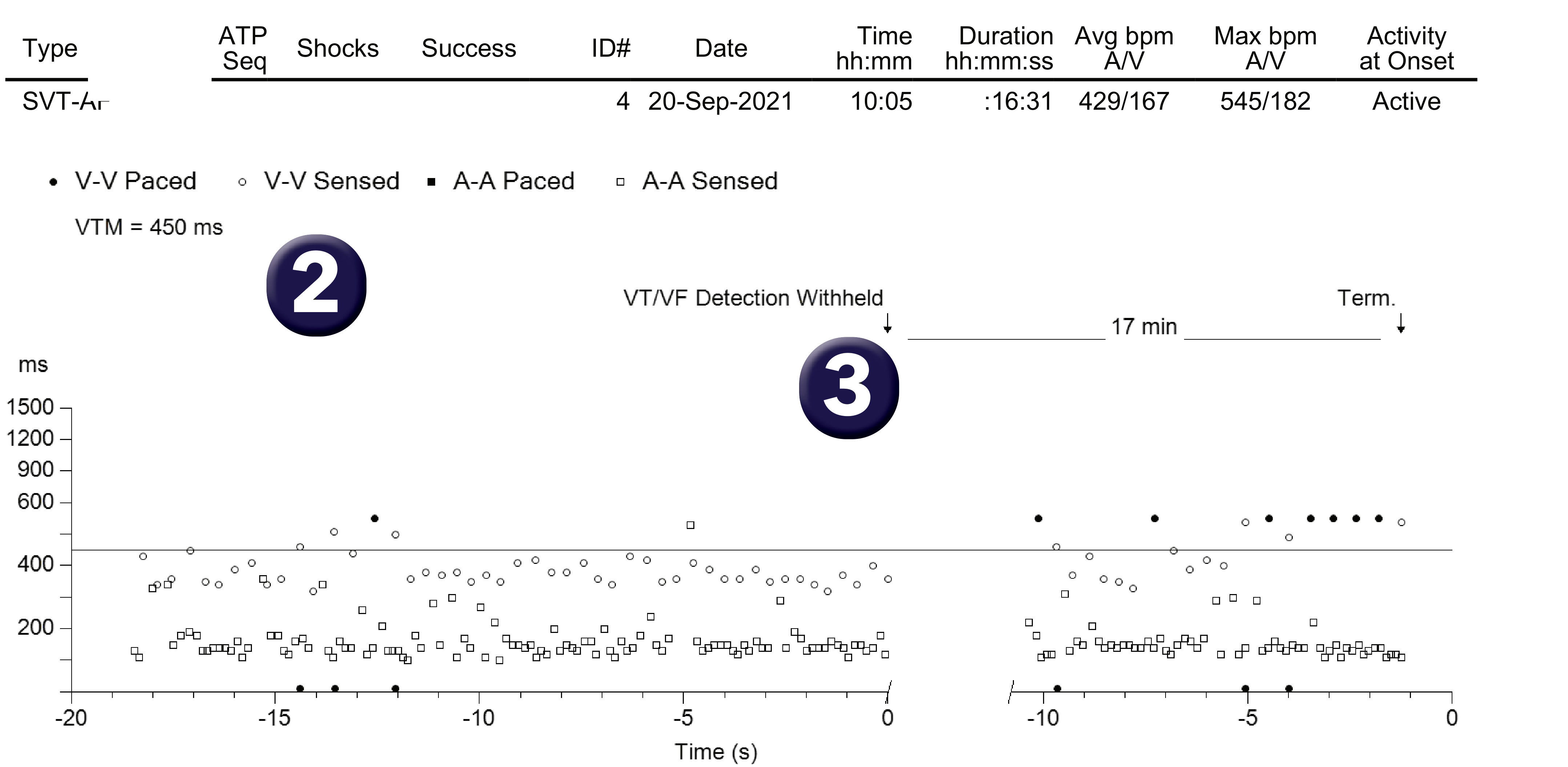 Medtronic ICD electrogram, segment 1 of 1 — PR Logic and conducted AF