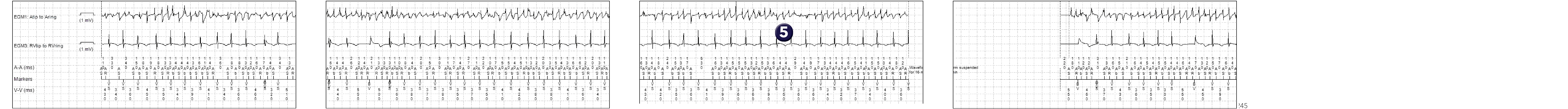 Medtronic ICD electrogram, segment 1 of 2 — PR Logic and conducted AF
