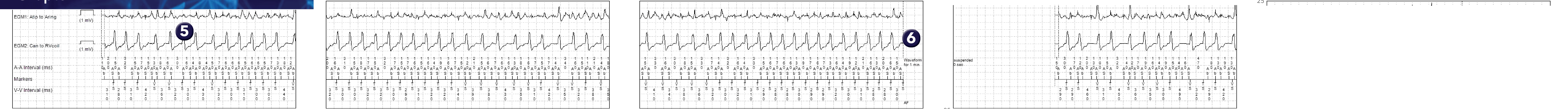 Medtronic ICD electrogram, segment 1 of 2 — Conducted AF, PR Logic and Wavelet