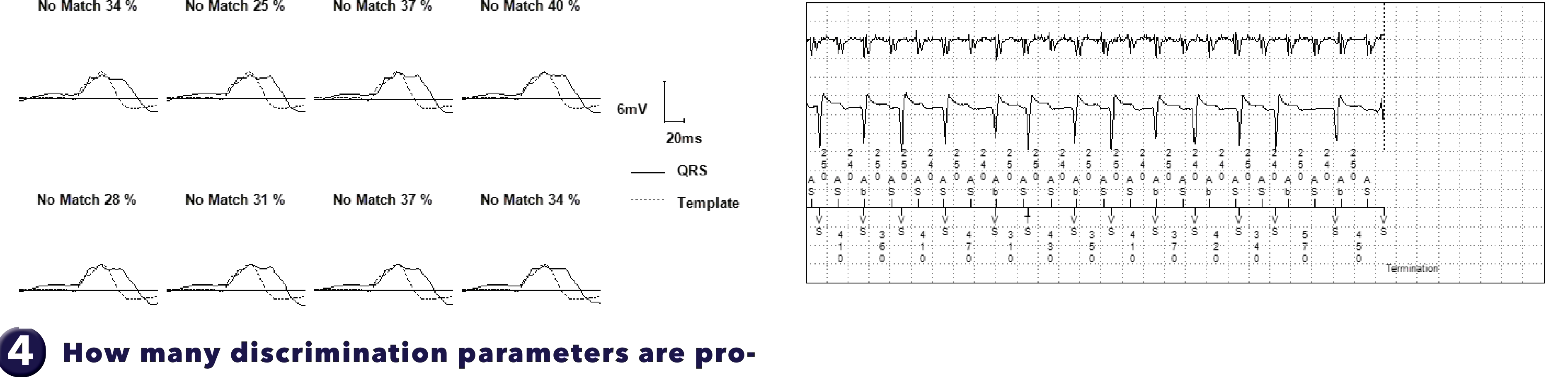 Medtronic ICD electrogram, segment 2 of 2 — Double-chamber discrimination and bi-tachycardia
