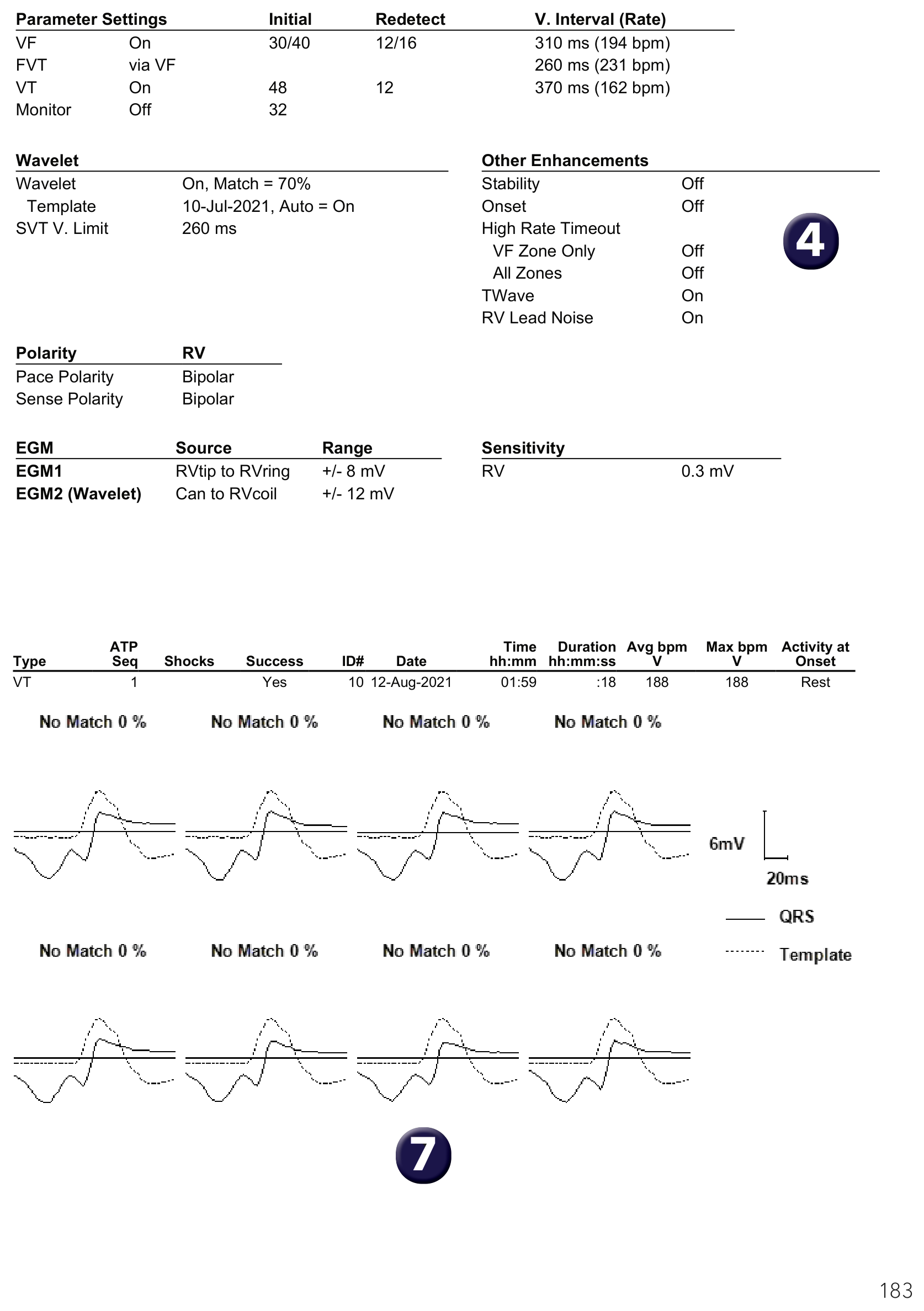 Medtronic ICD electrogram, segment 2 of 2 — Choice of discriminators in a single-chamber defibrillator