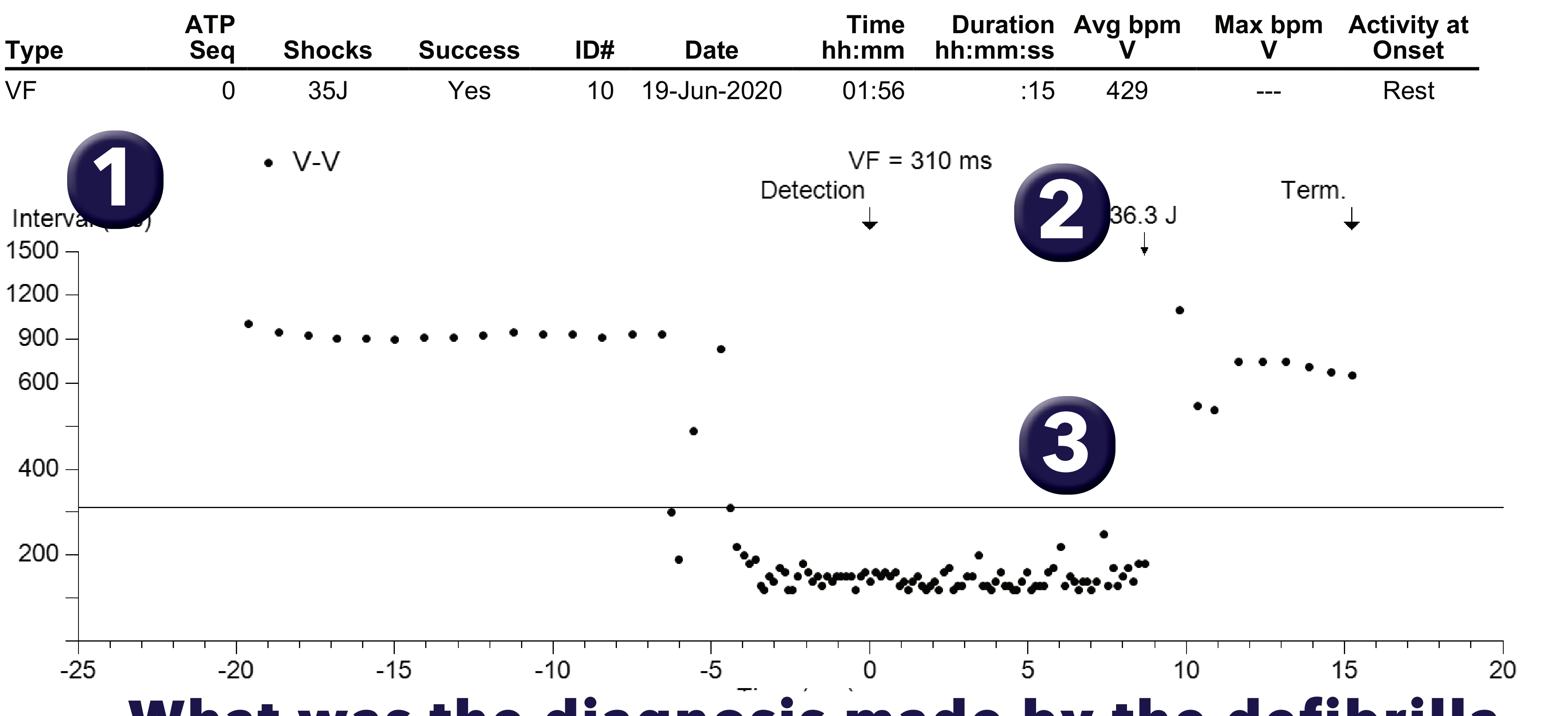 Medtronic ICD electrogram, segment 1 of 1 — Single-chamber defibrillator and SVT V. Limit