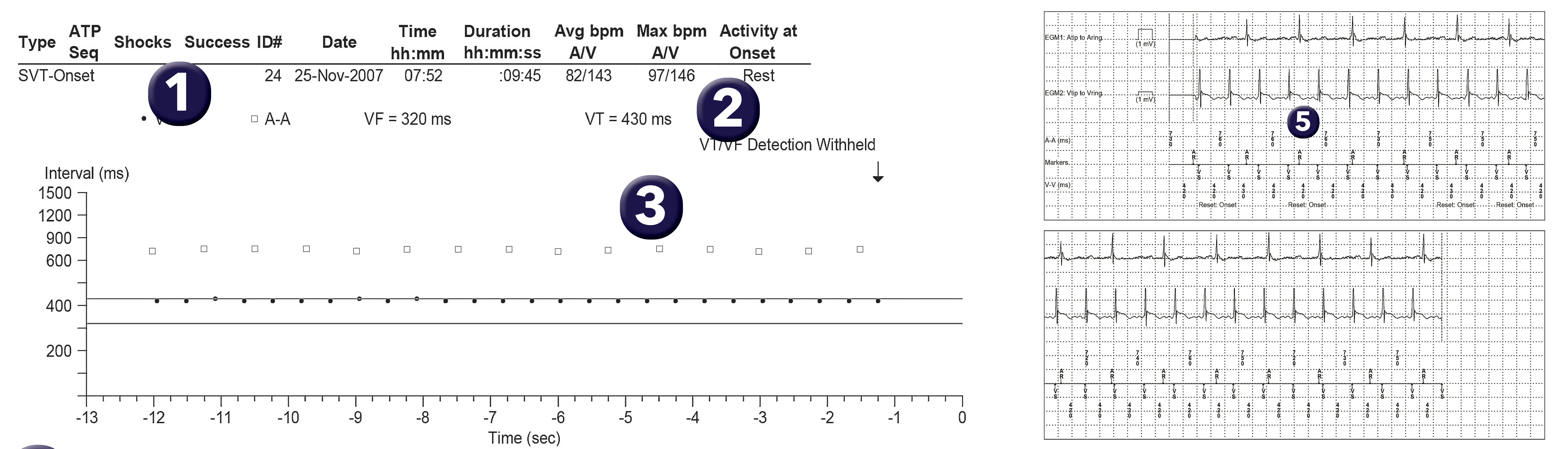 Medtronic ICD electrogram, segment 1 of 1 — Using single-chamber discriminators in a dual-chamber defibrillator