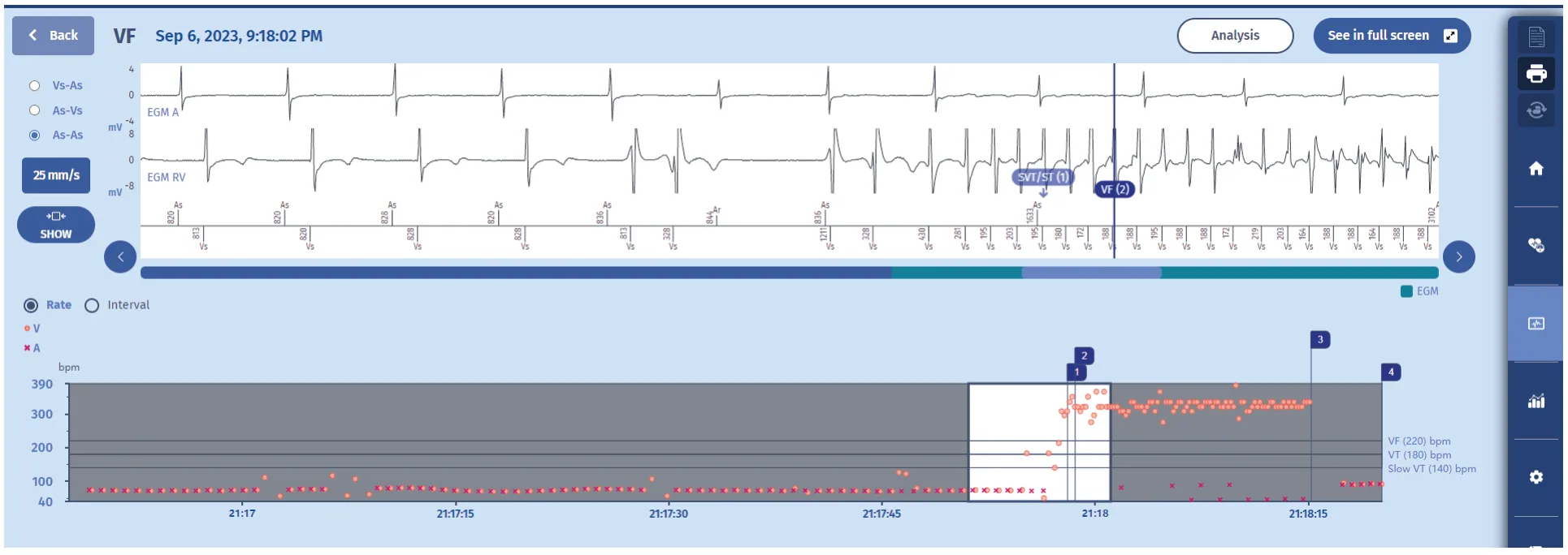 MicroPort ICD, Episode review — Counting and diagnosis of ventricular fibrillation