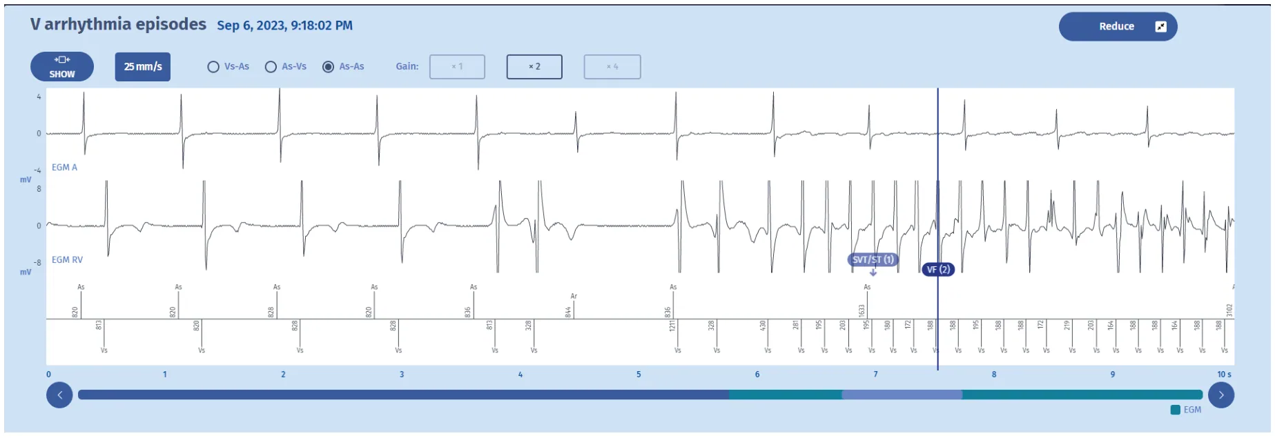 MicroPort ICD, Electrogram: beginning — Counting and diagnosis of ventricular fibrillation