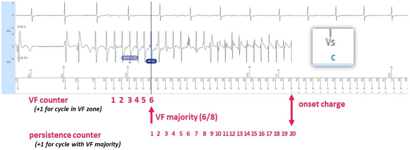 MicroPort ICD, Electrogram: beginning — Counting and diagnosis of ventricular fibrillation