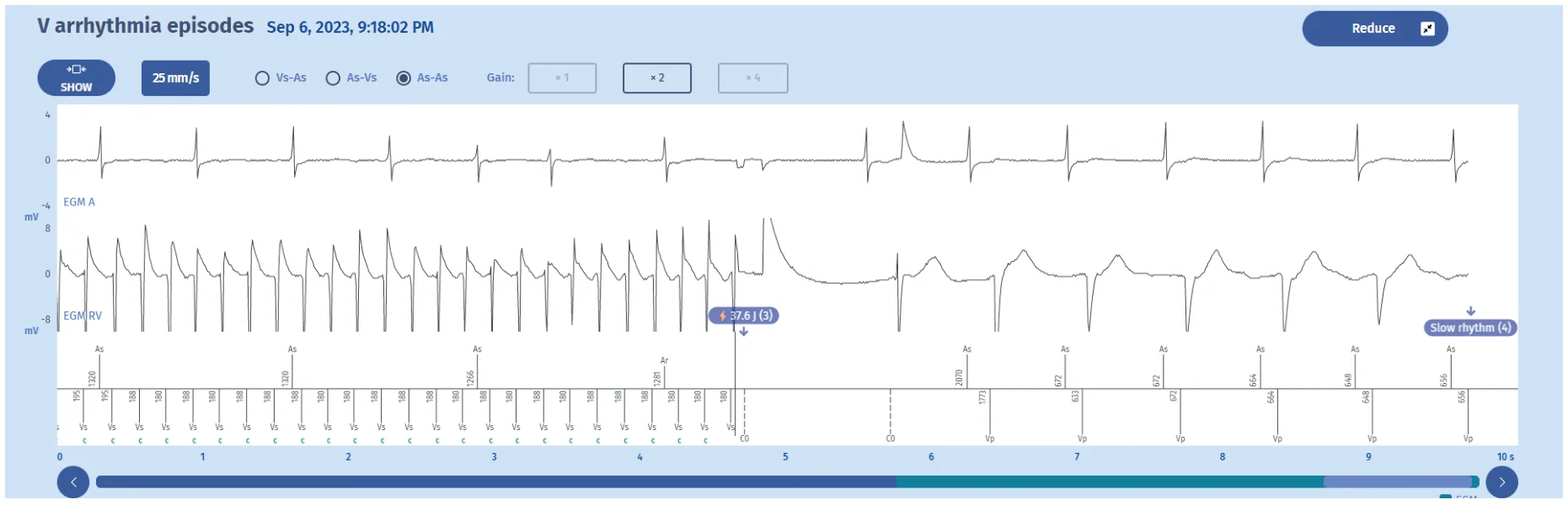 MicroPort ICD, Electrogram: end — Counting and diagnosis of ventricular fibrillation