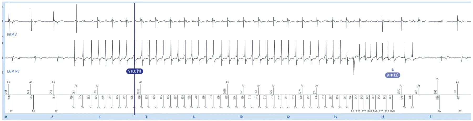 MicroPort ICD, Overview of the full EGM — Counting in the VT zone