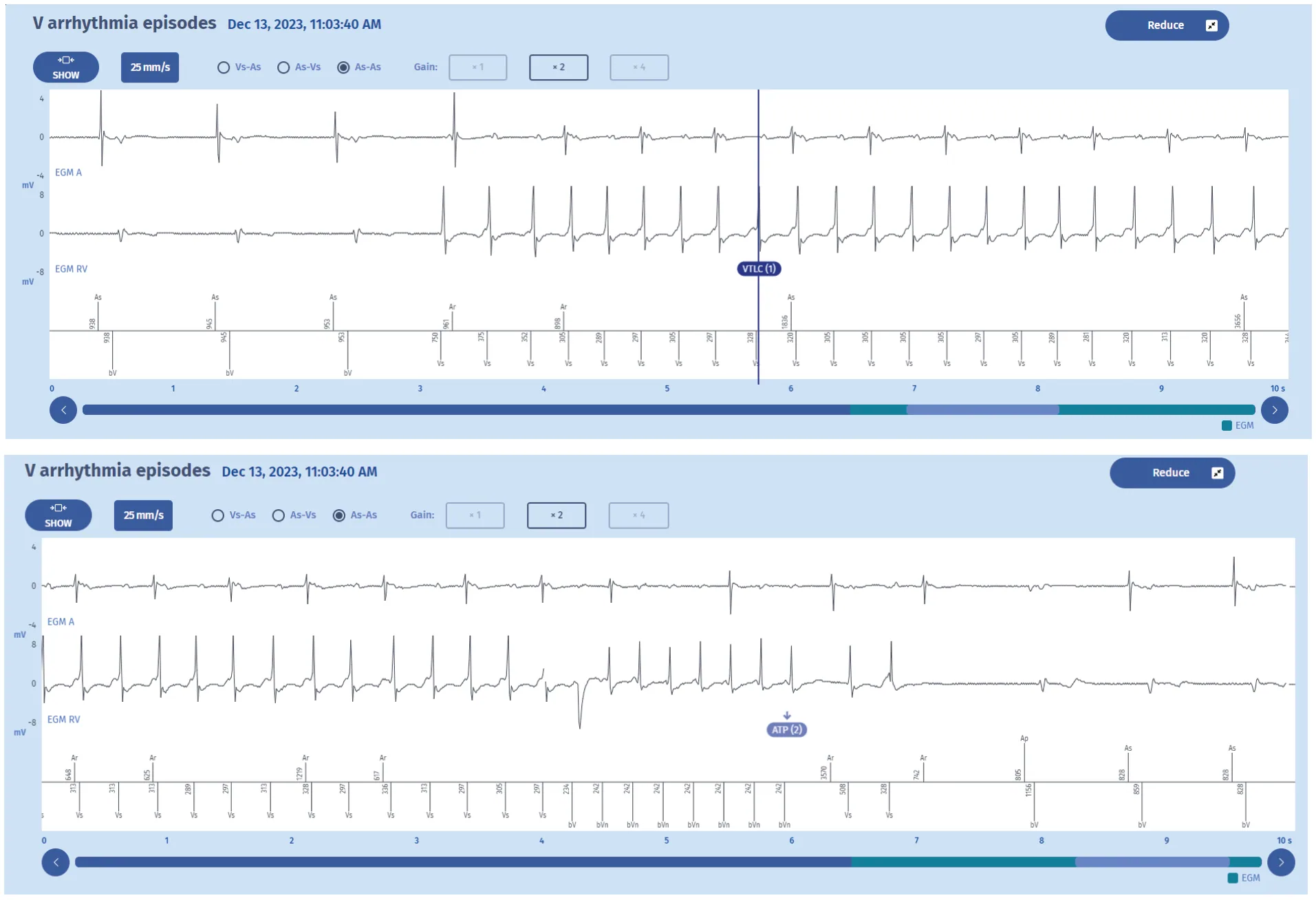 MicroPort ICD, EGM — Counting in the VT zone