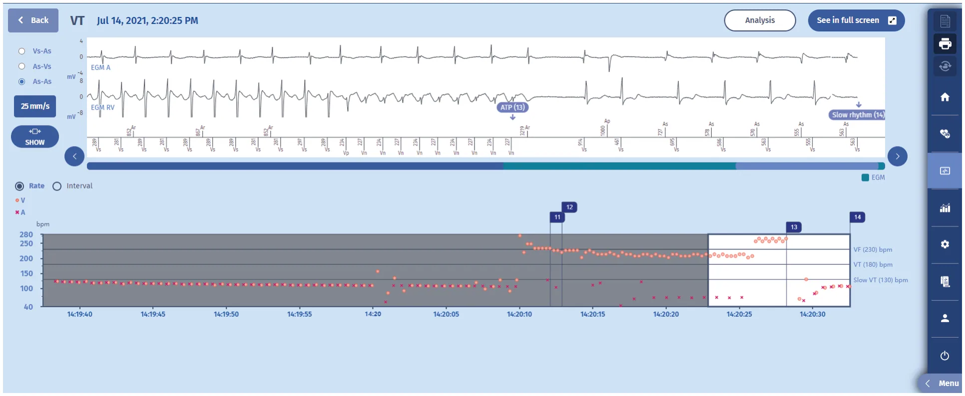 MicroPort ICD, The newest episode with therapy is the following: — Long VT