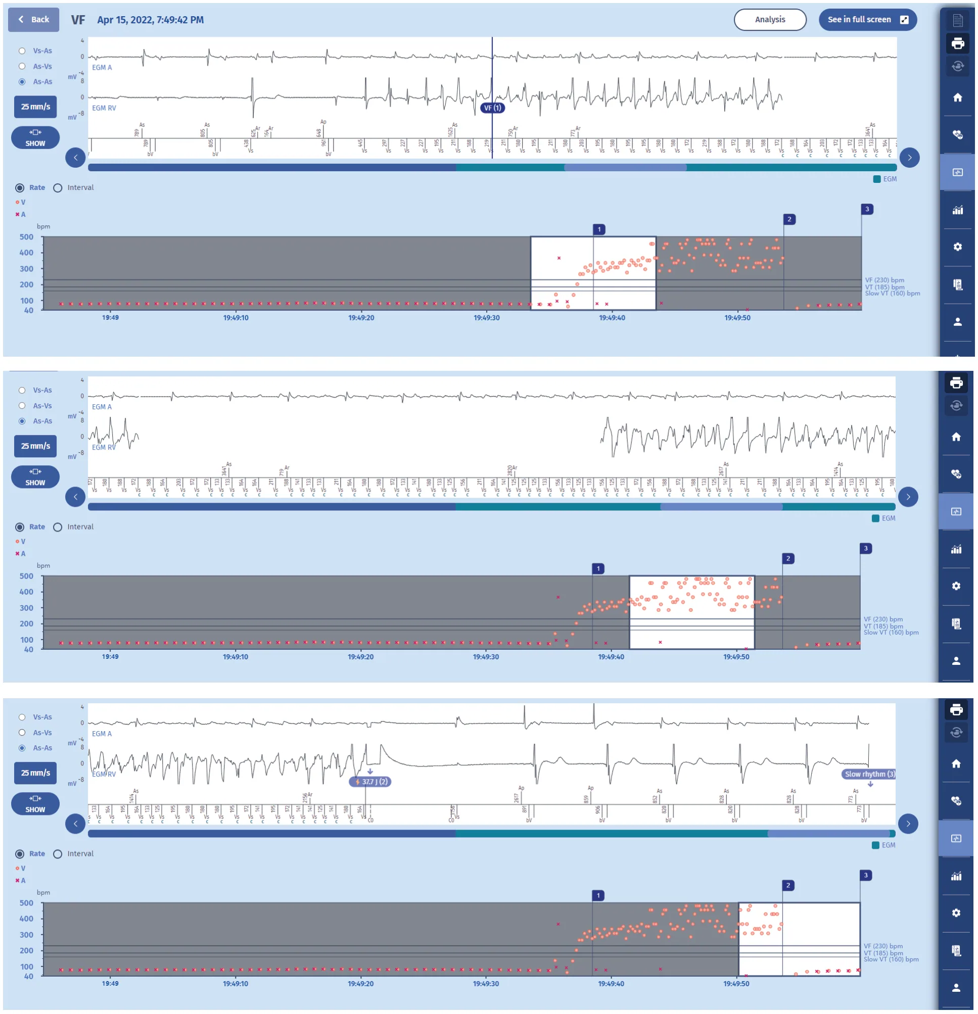 MicroPort ICD, The following three screens show the episode: — Tachycardia treated with a shock