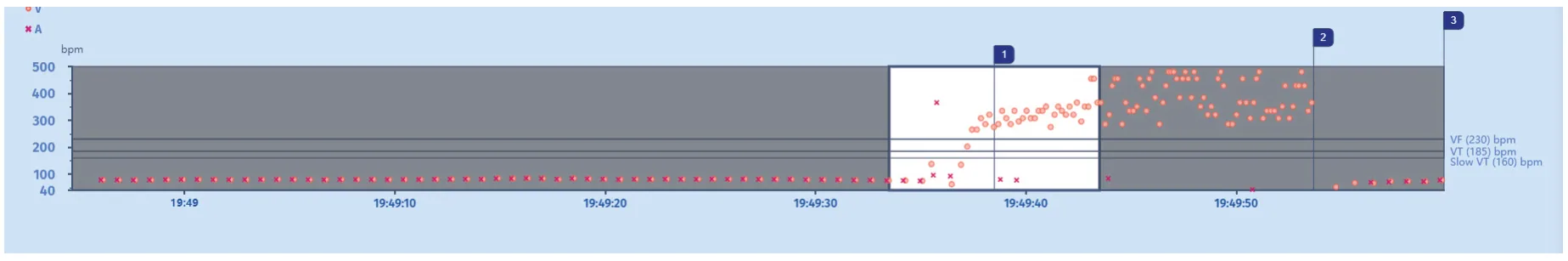 MicroPort ICD, Interval plot — Tachycardia treated with a shock