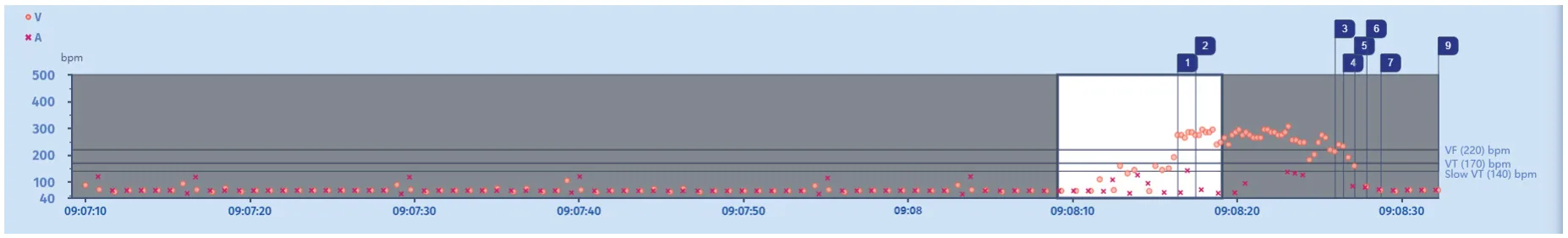 MicroPort ICD, Interval plot — Tachycardia treated with a shock, or is it?