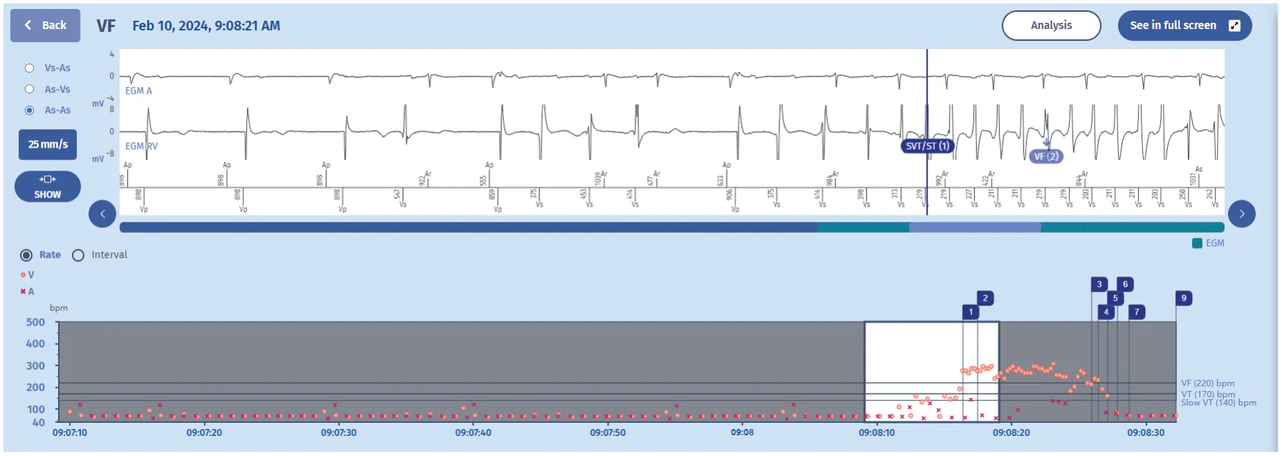 MicroPort ICD, EGM — Tachycardia treated with a shock, or is it?