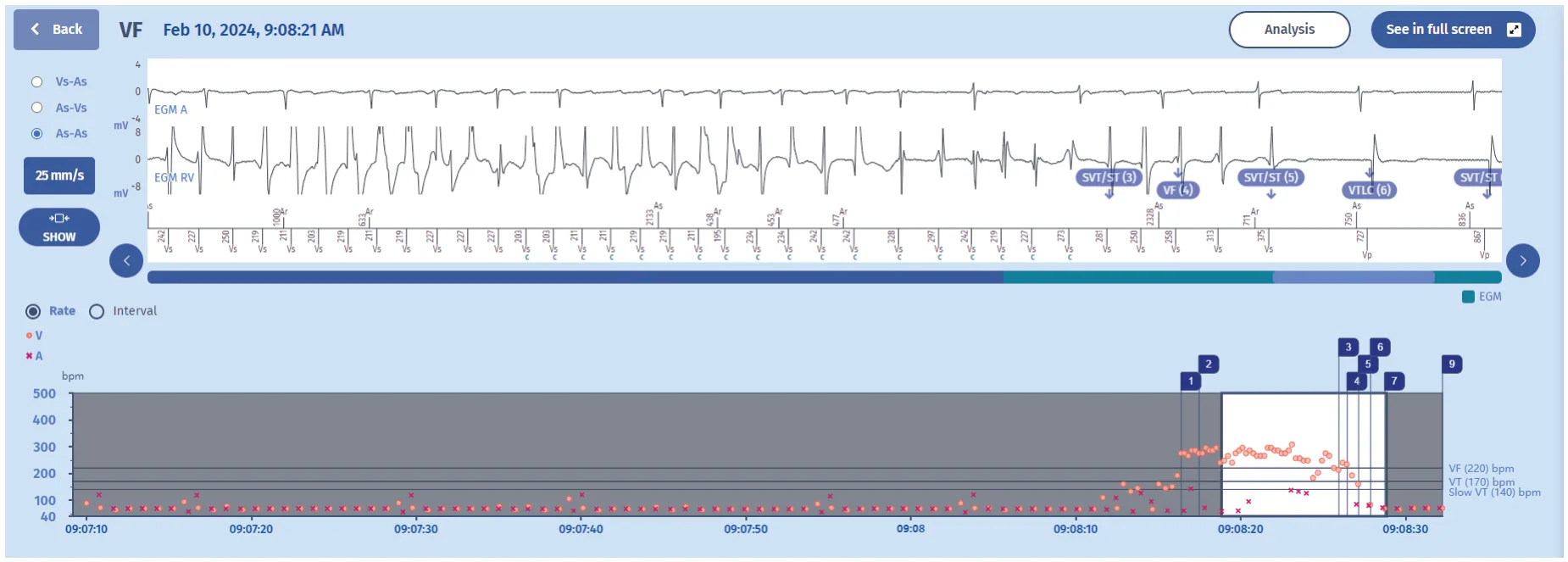 MicroPort ICD, EGM — Tachycardia treated with a shock, or is it?
