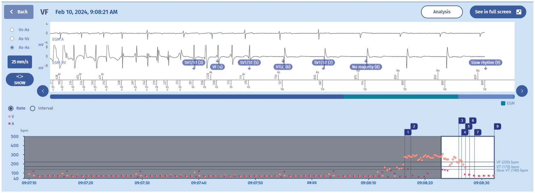 MicroPort ICD, EGM — Tachycardia treated with a shock, or is it?