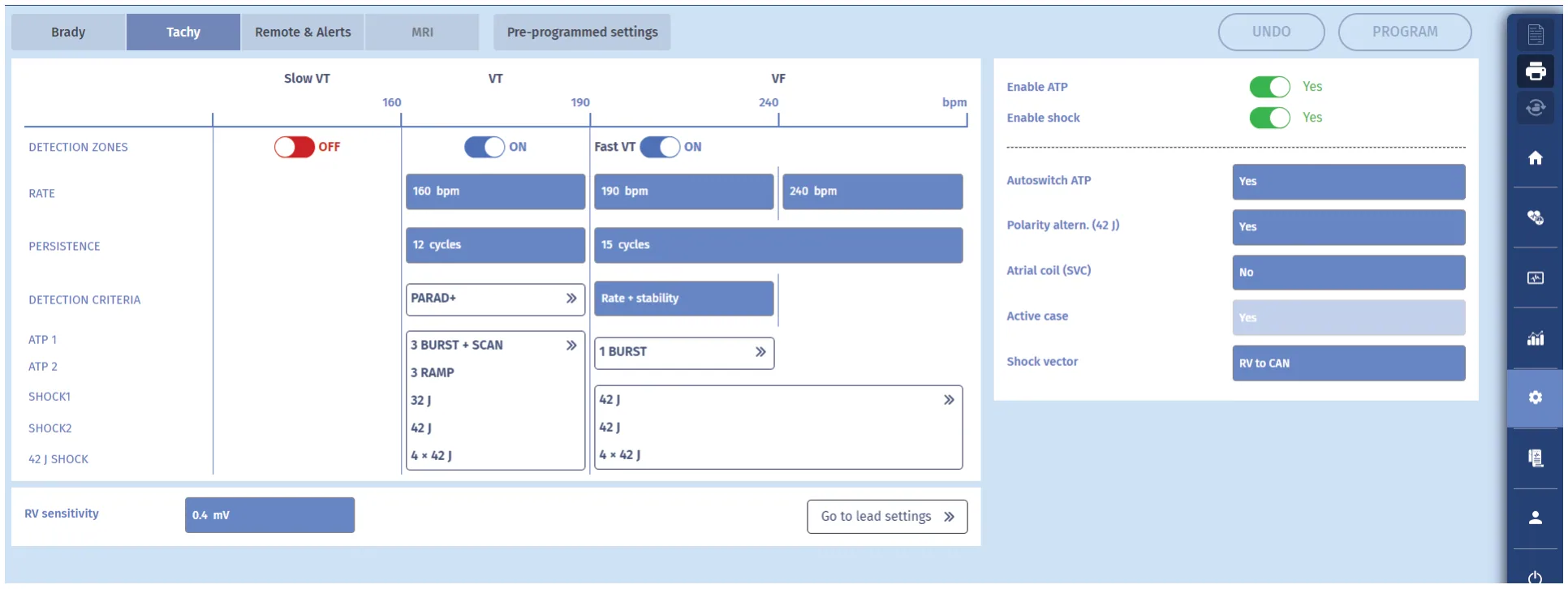 MicroPort ICD, You interrogate the device — Tachycardia treated by an ATP burst