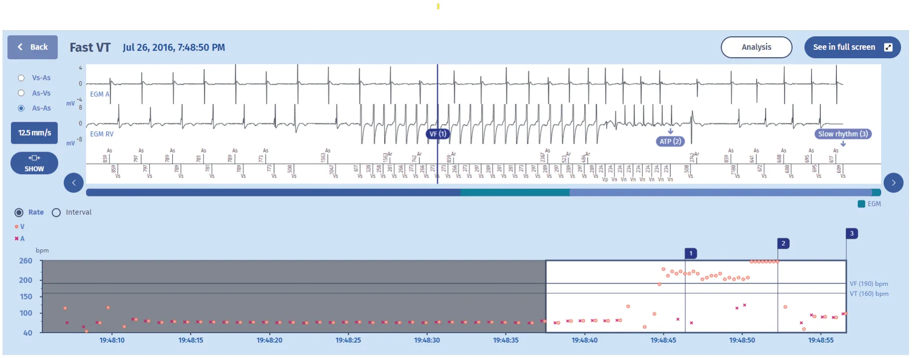MicroPort ICD, You interrogate the device — Tachycardia treated by an ATP burst