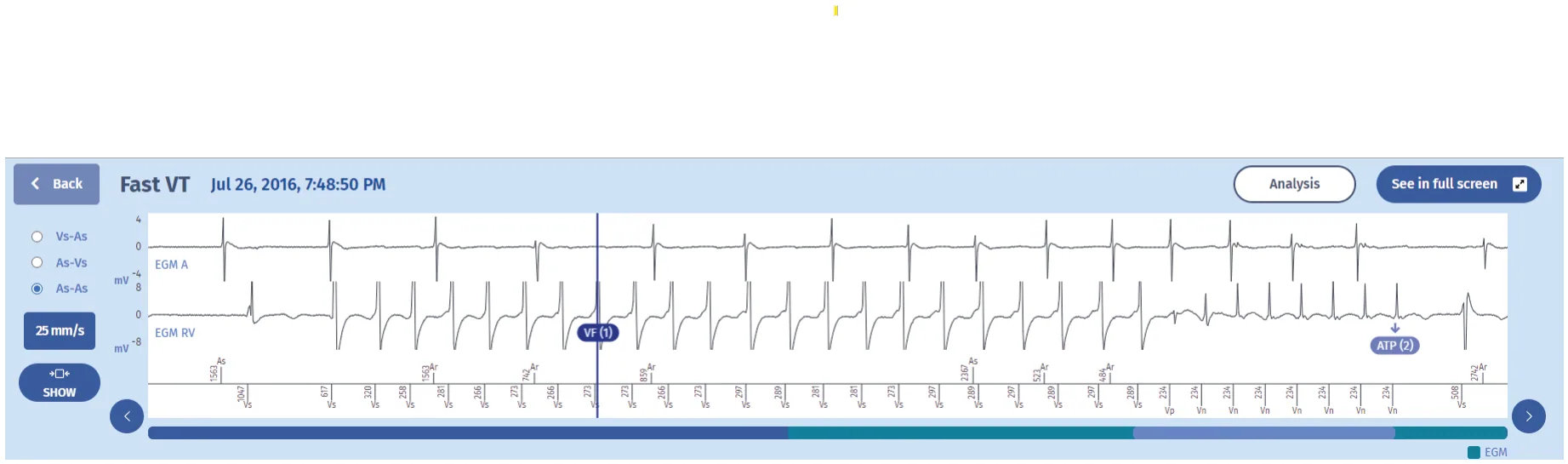 MicroPort ICD, Interval plot — Tachycardia treated by an ATP burst