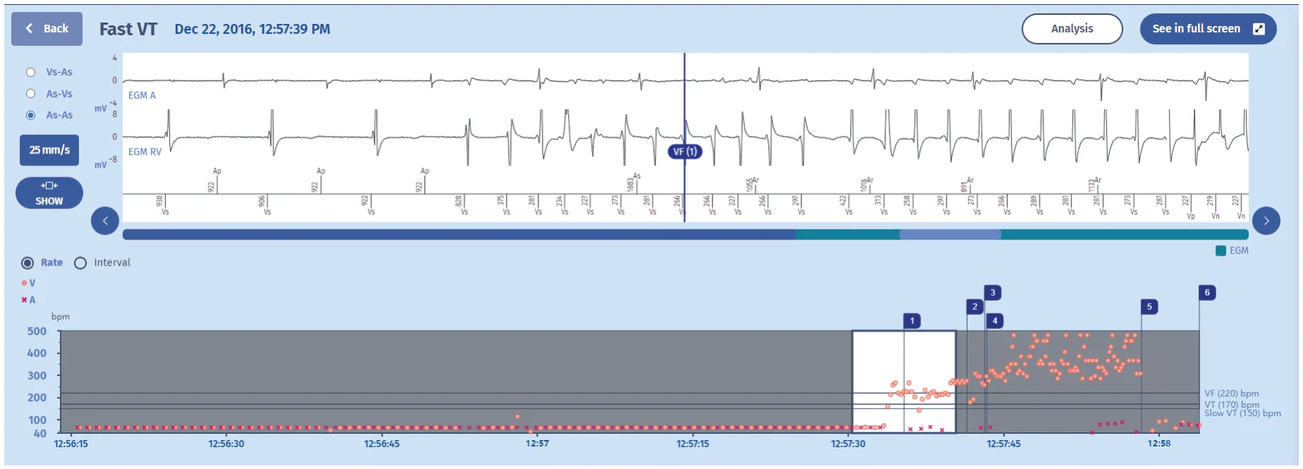 MicroPort ICD, EGM — Fast tachycardia accelerated by therapy