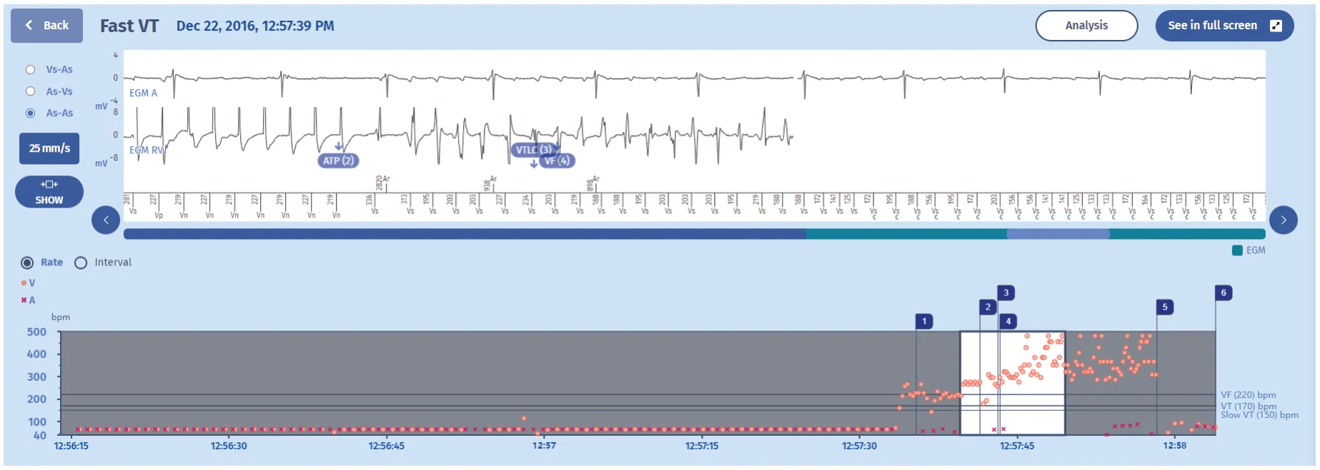 MicroPort ICD, EGM — Fast tachycardia accelerated by therapy