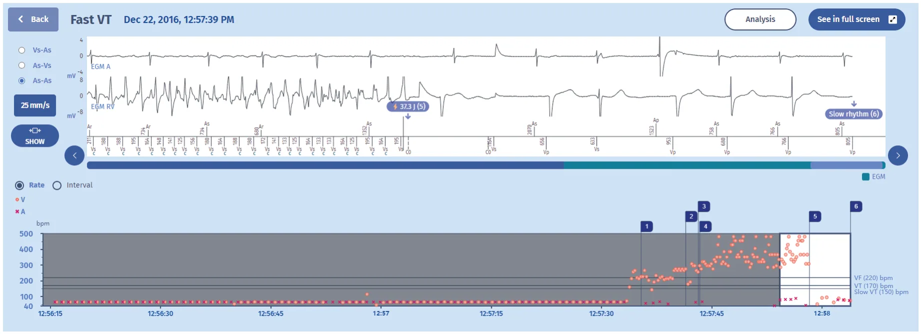 MicroPort ICD, EGM — Fast tachycardia accelerated by therapy