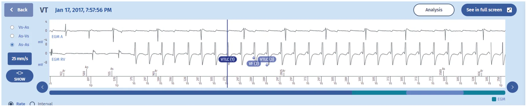 MicroPort ICD, EGM — Tachycardia treated by an ATP burst