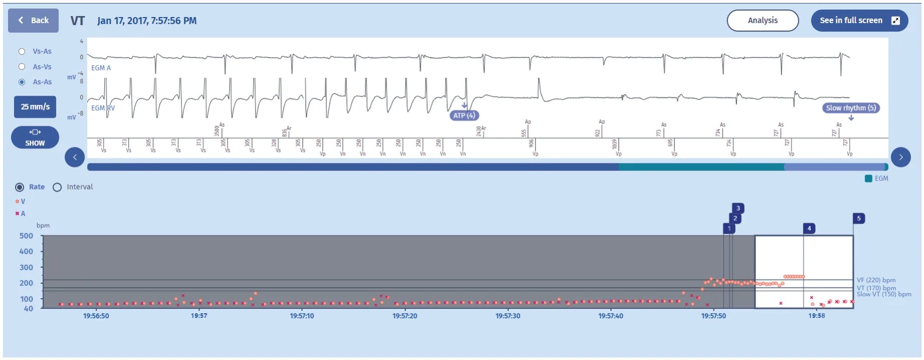 MicroPort ICD, EGM — Tachycardia treated by an ATP burst