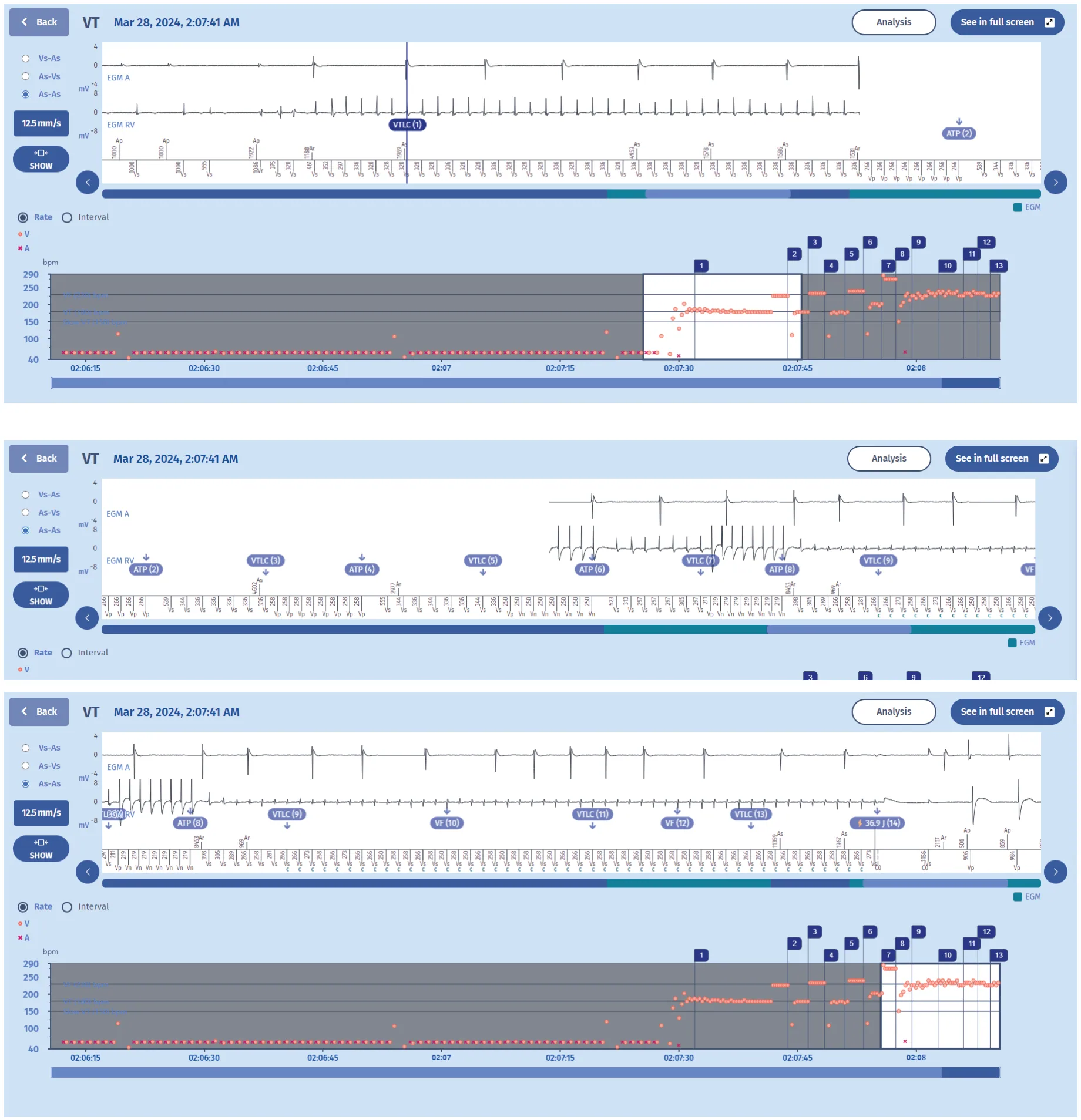 MicroPort ICD, EGM — Possible deleterious effect of antitachycardia pacing