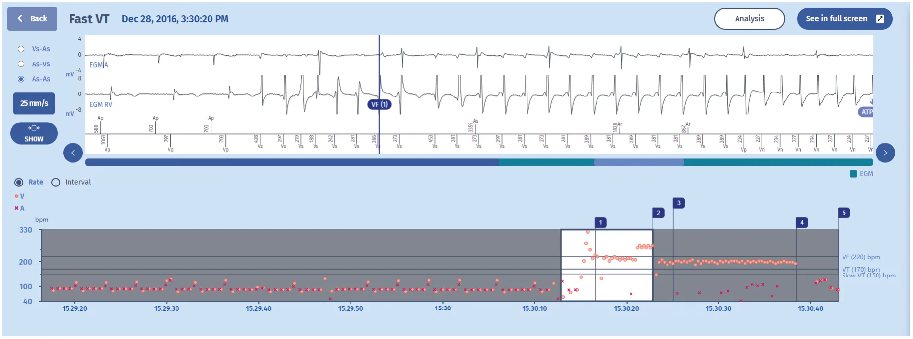 MicroPort ICD, EGM — Levels of aggressiveness