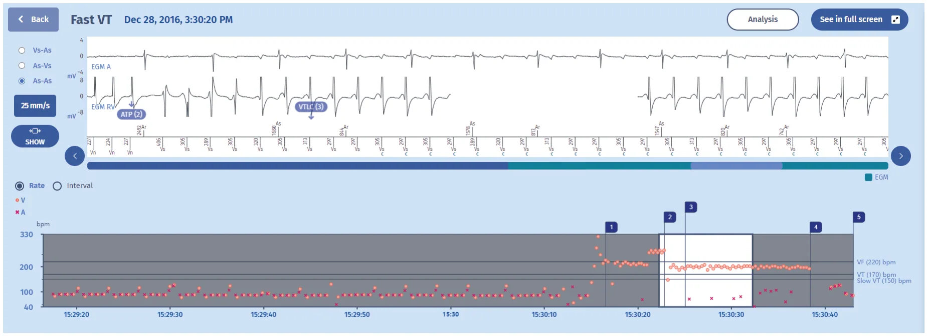 MicroPort ICD, EGM — Levels of aggressiveness