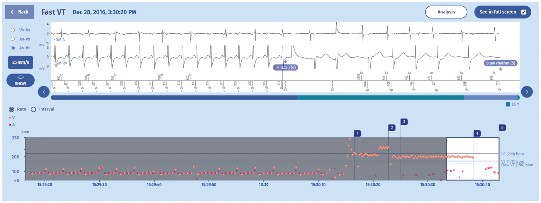 MicroPort ICD, EGM — Levels of aggressiveness
