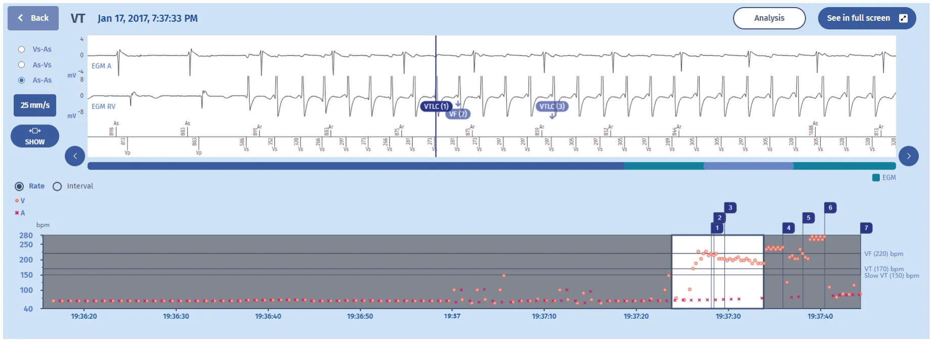 MicroPort ICD, EGM — Tachycardia and zones