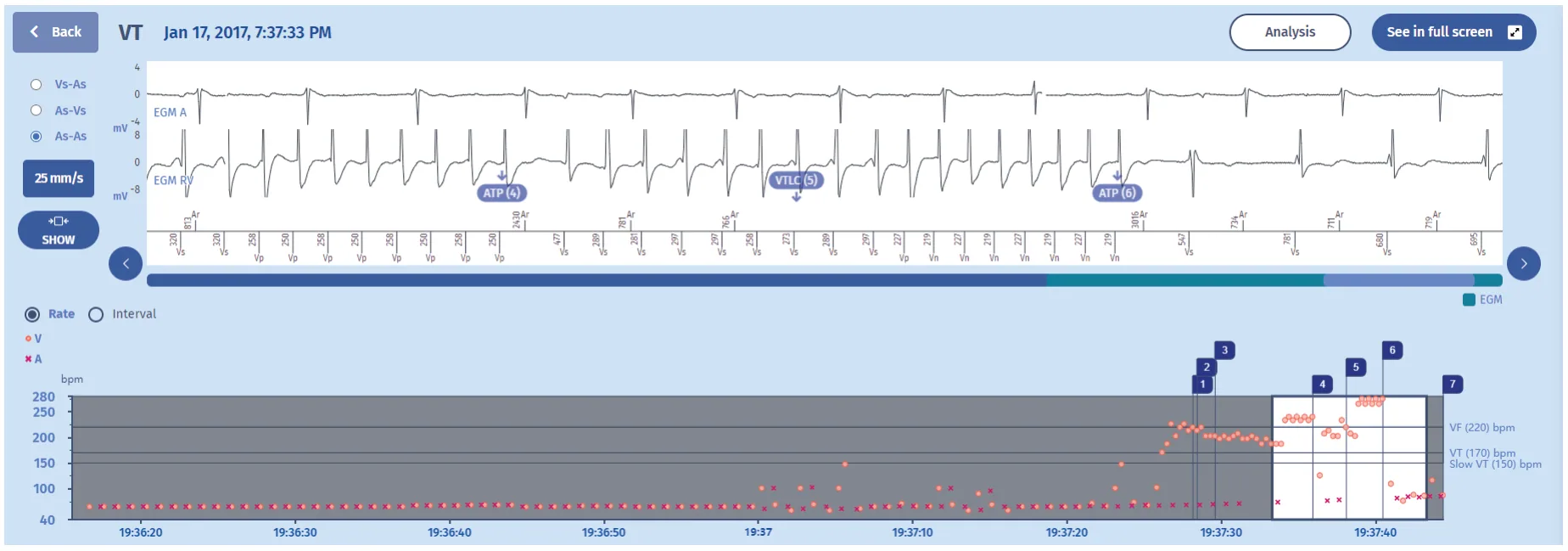 MicroPort ICD, EGM — Tachycardia and zones