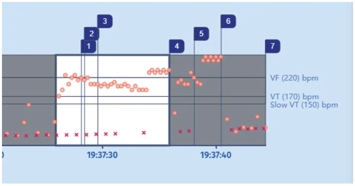 MicroPort ICD, Interval plot — Tachycardia and zones