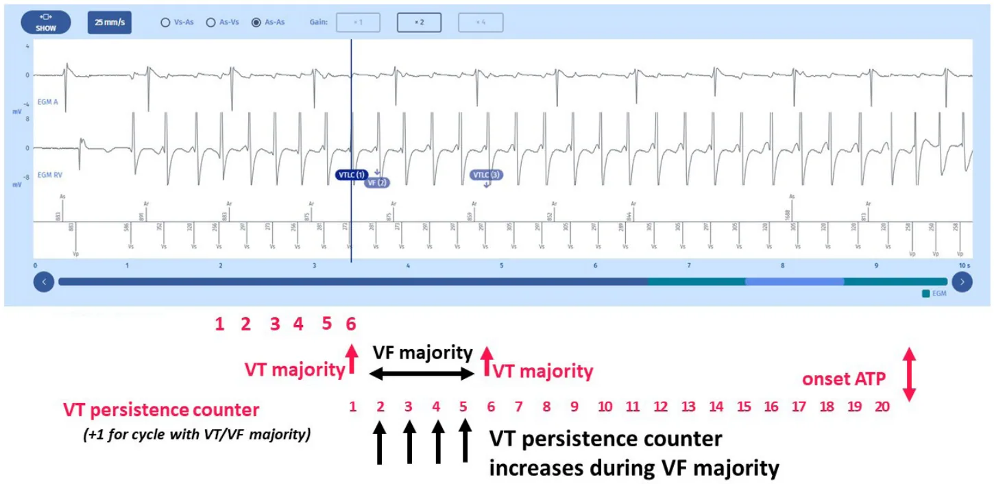 MicroPort ICD, EGM — Tachycardia and zones