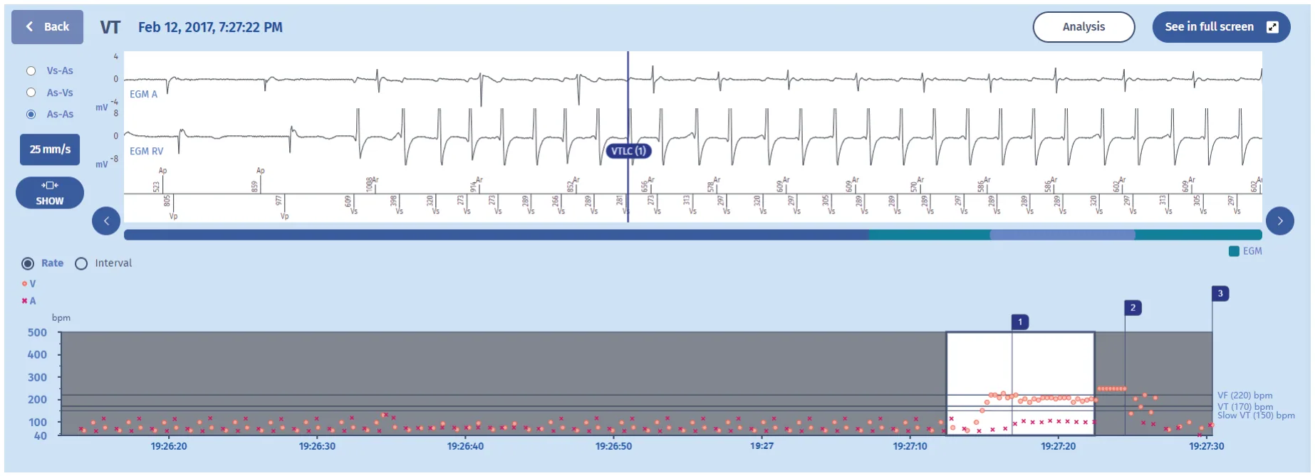MicroPort ICD, EGM — Termination by ATP?