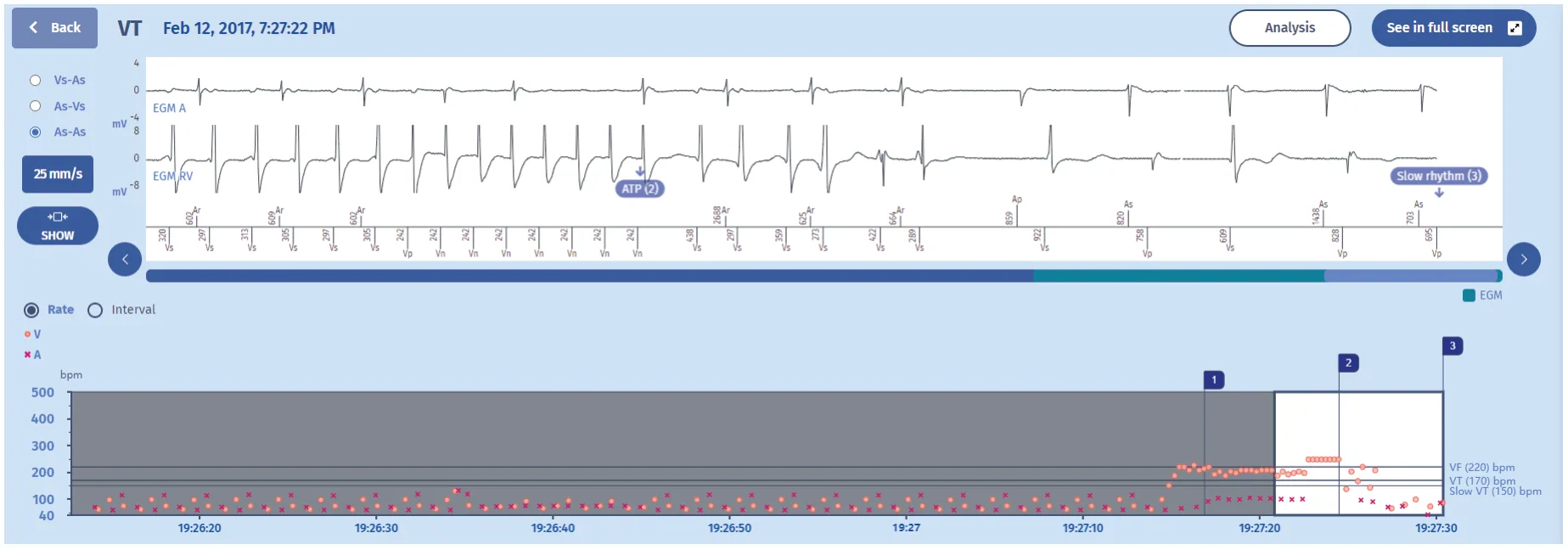 MicroPort ICD, EGM — Termination by ATP?