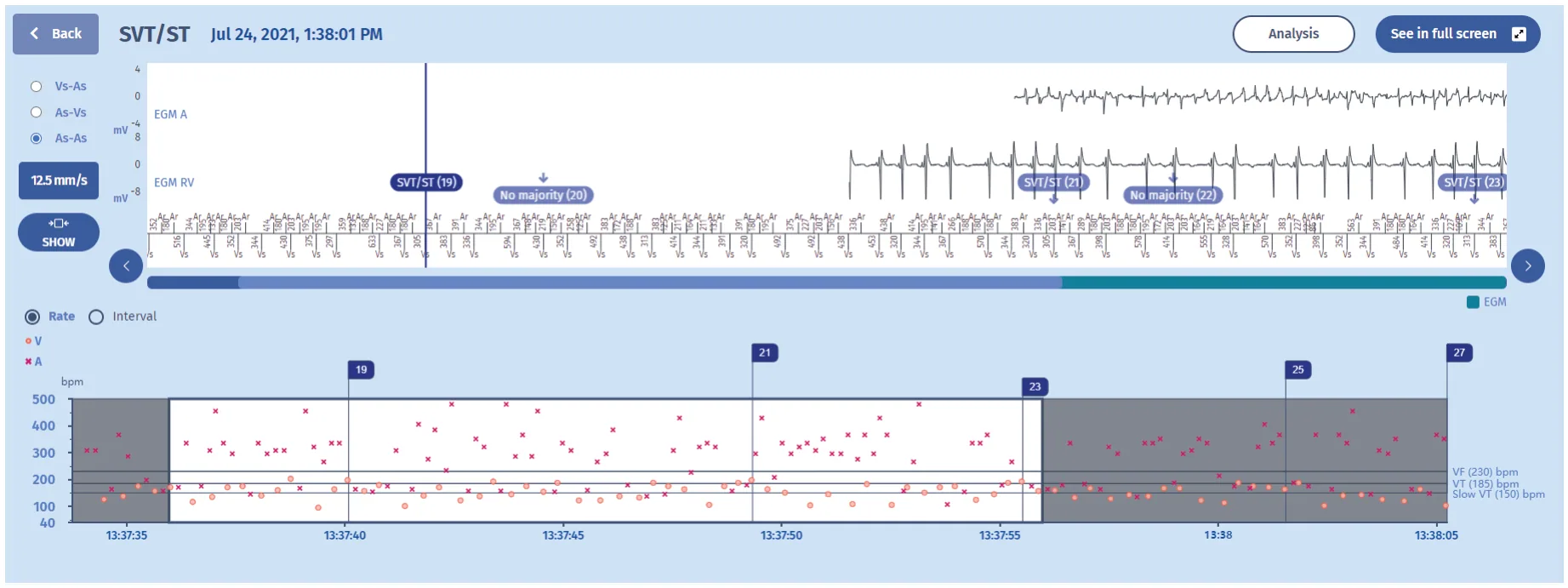 MicroPort ICD, EGM — Stability as the great discriminator