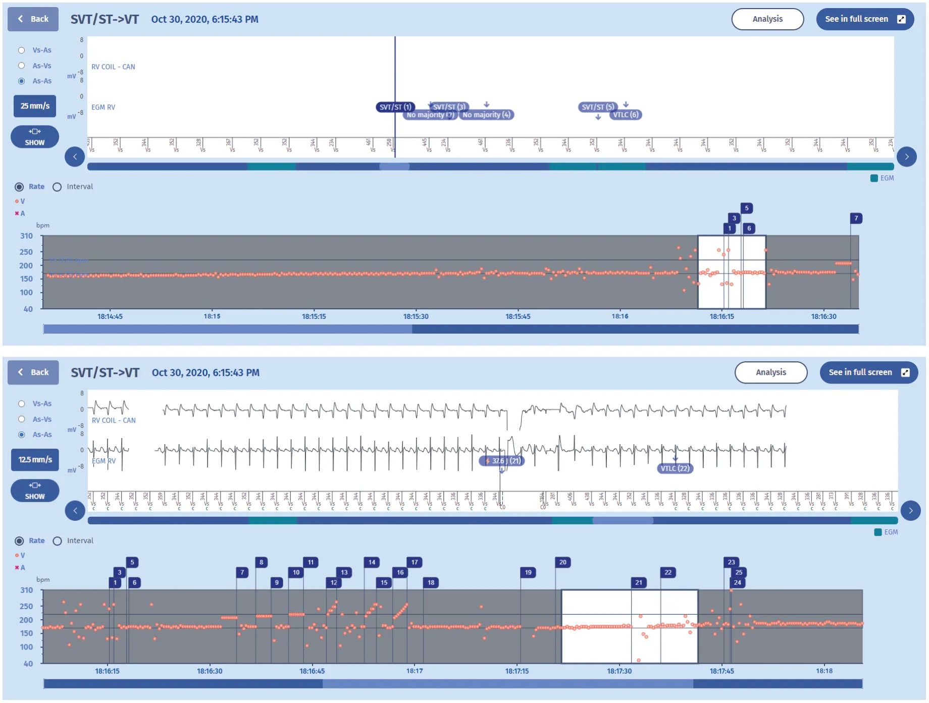 MicroPort ICD, EGM — What about morphology?
